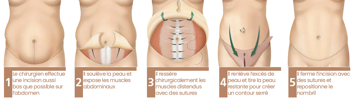 Abdominoplastie Sousse Tunisie
