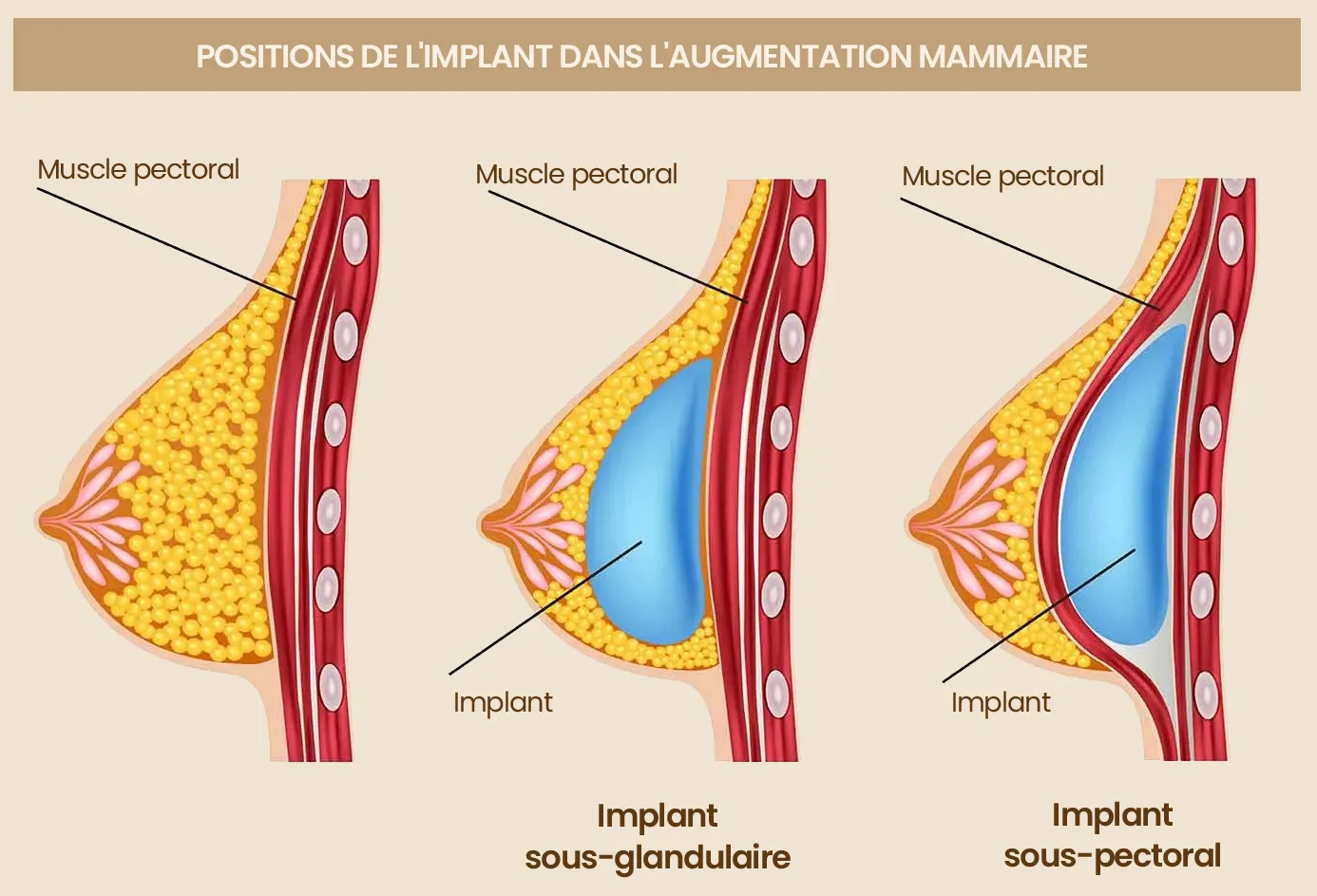 Augmentation mammaire Sousse Tunisie