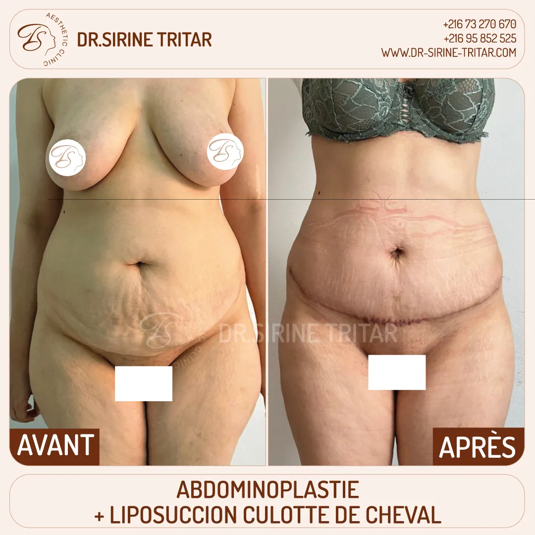 Abdominoplastie Sousse Tunisie