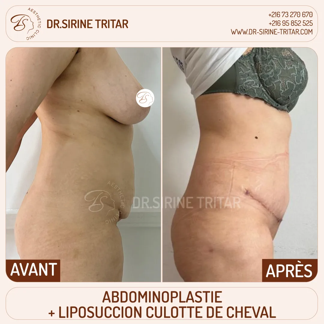 Abdominoplastie Sousse Tunisie
