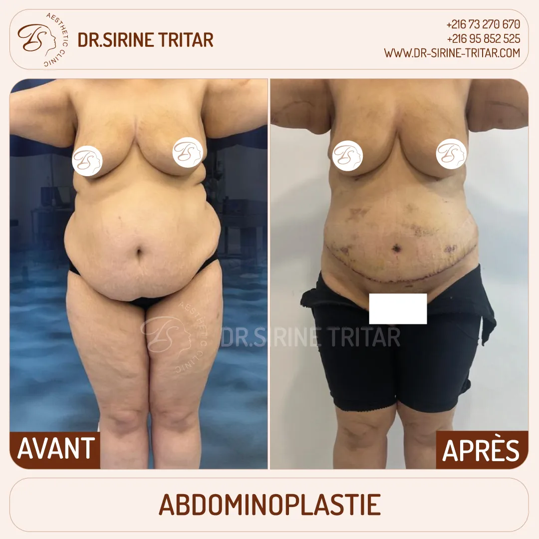 Abdominoplastie Sousse Tunisie
