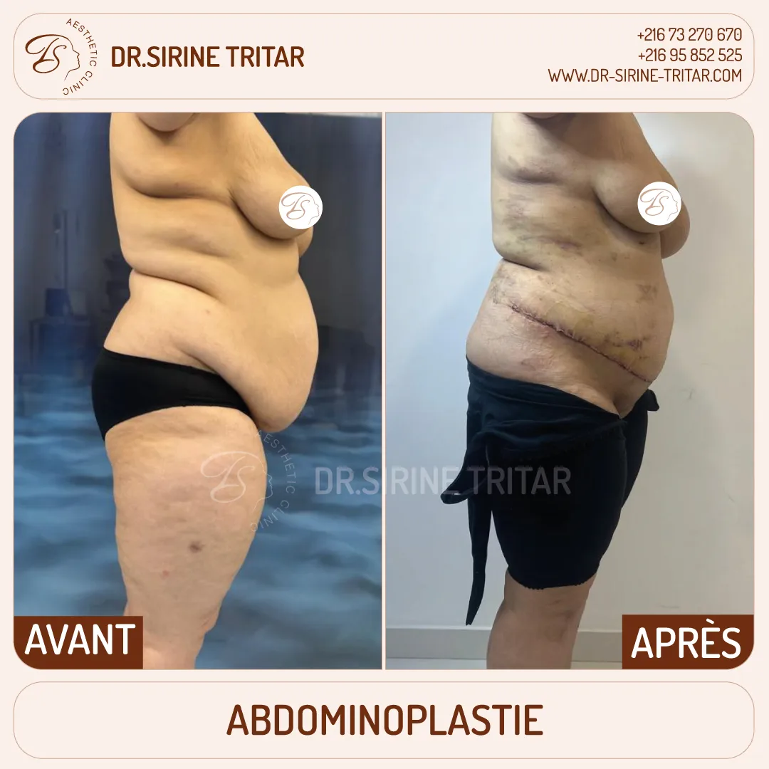 Abdominoplastie Sousse Tunisie