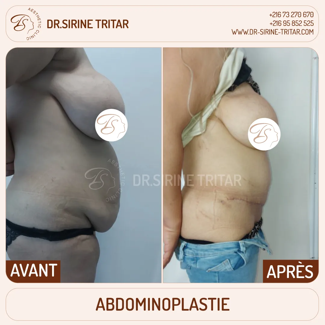 Abdominoplastie Sousse Tunisie