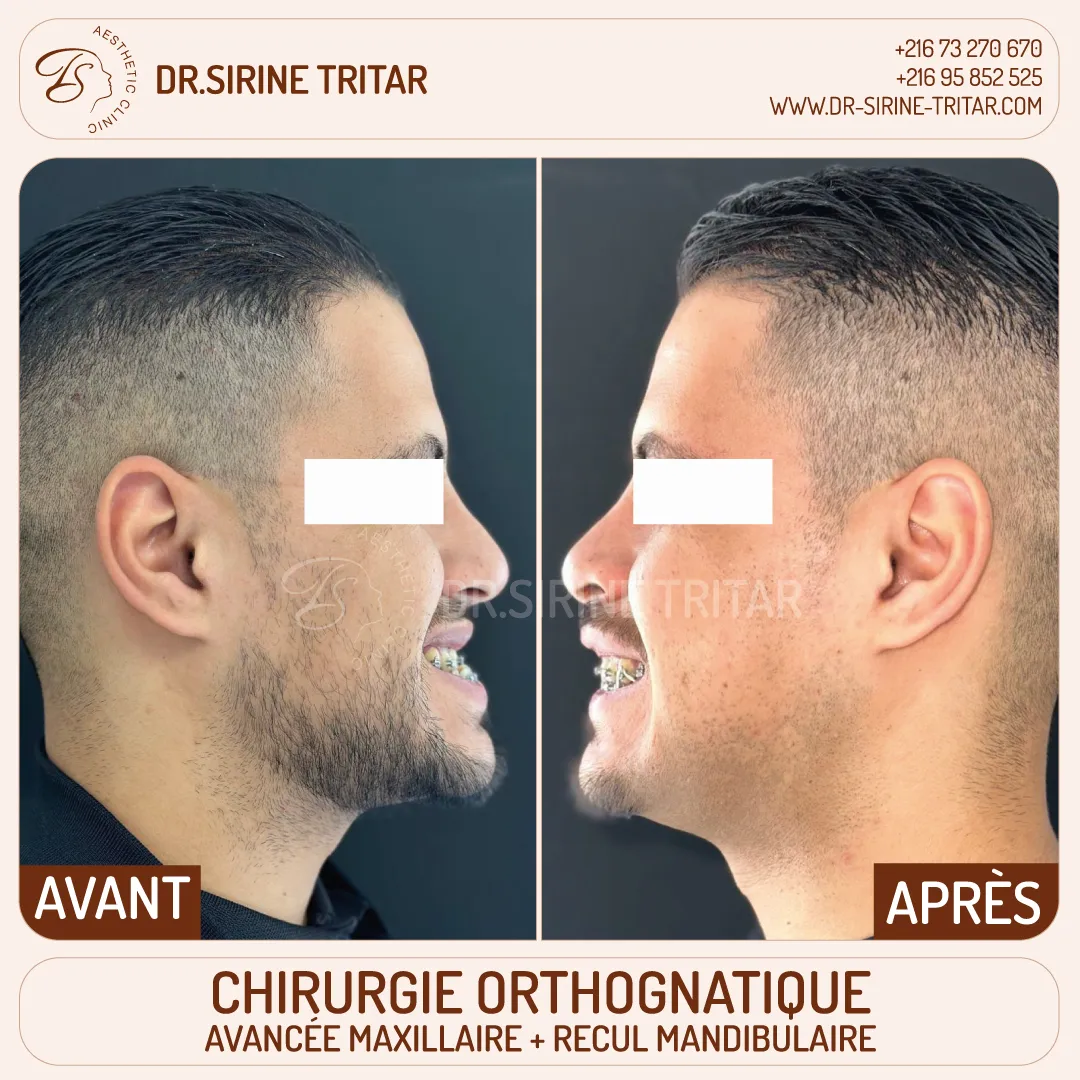 Chirurgie orthognatique Sousse Tunisie