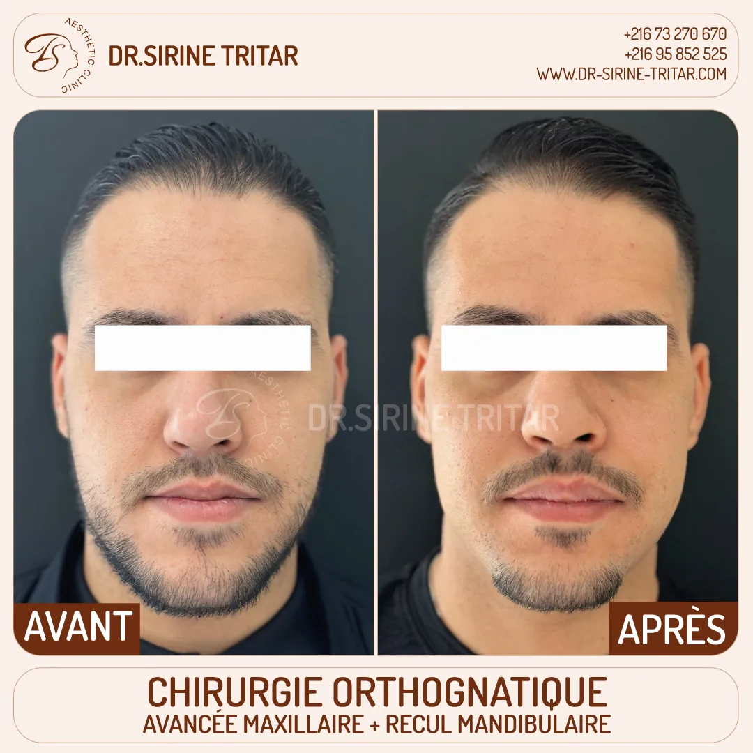 Chirurgie orthognatique Sousse Tunisie