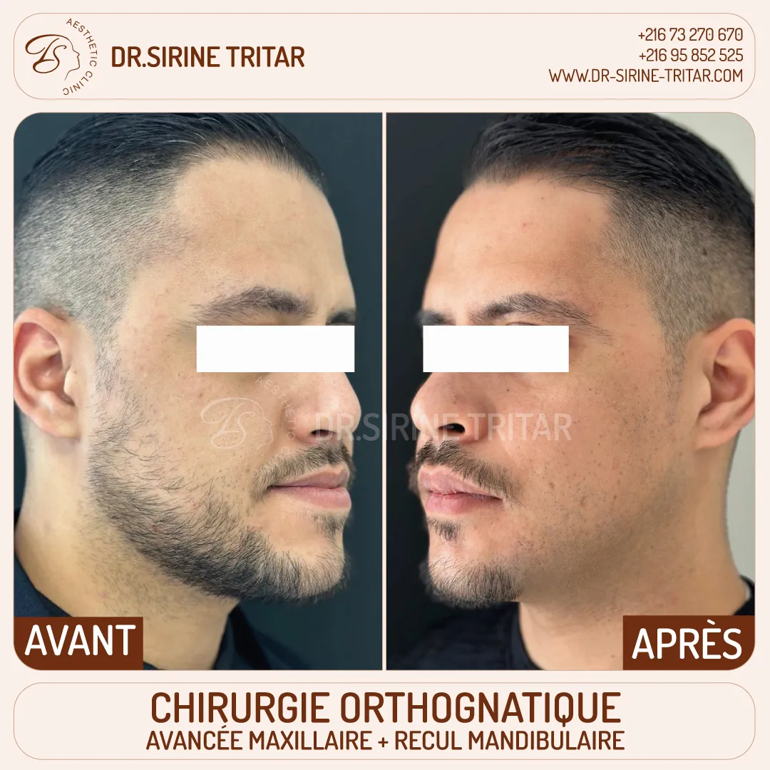 Chirurgie orthognatique Sousse Tunisie
