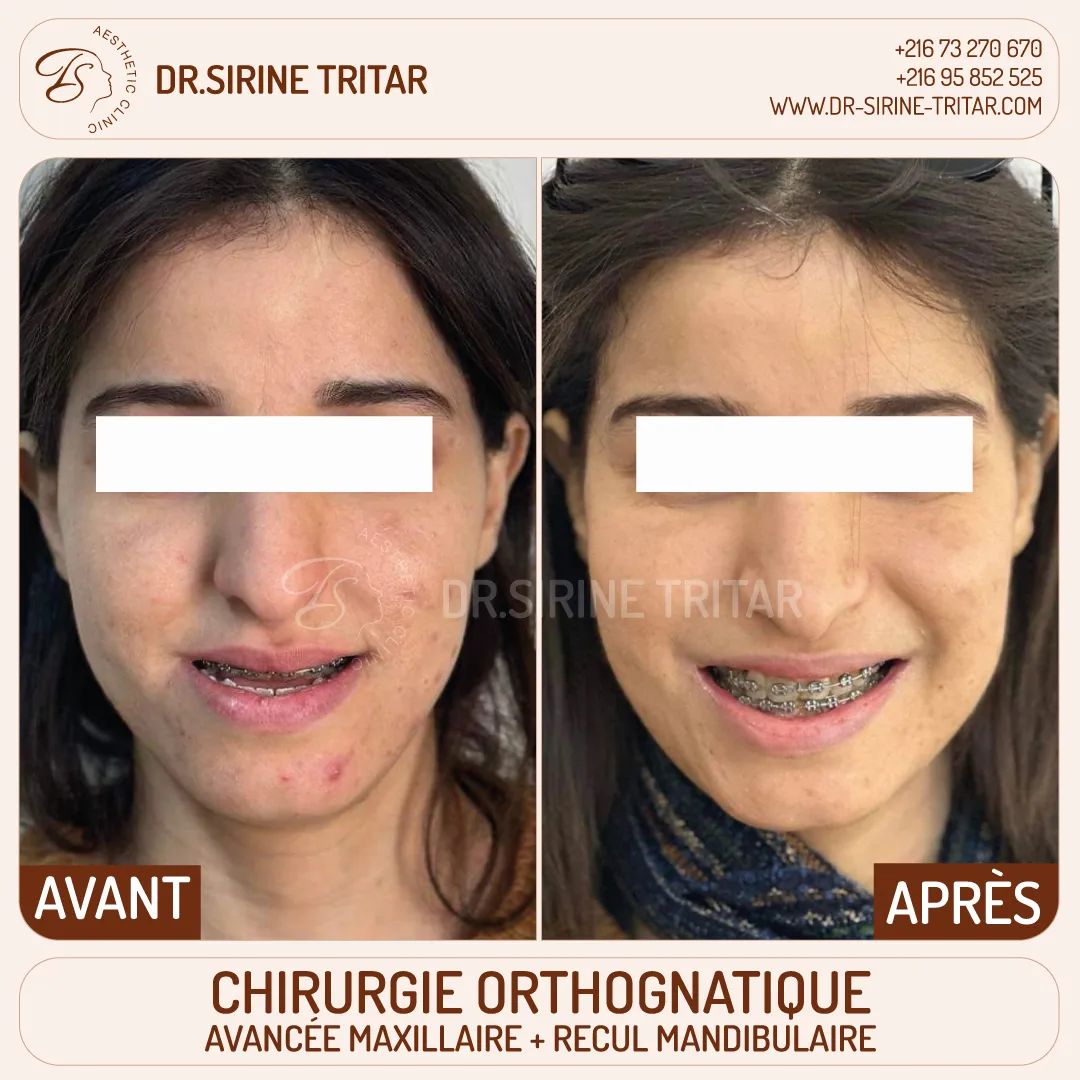 Chirurgie orthognatique Sousse Tunisie