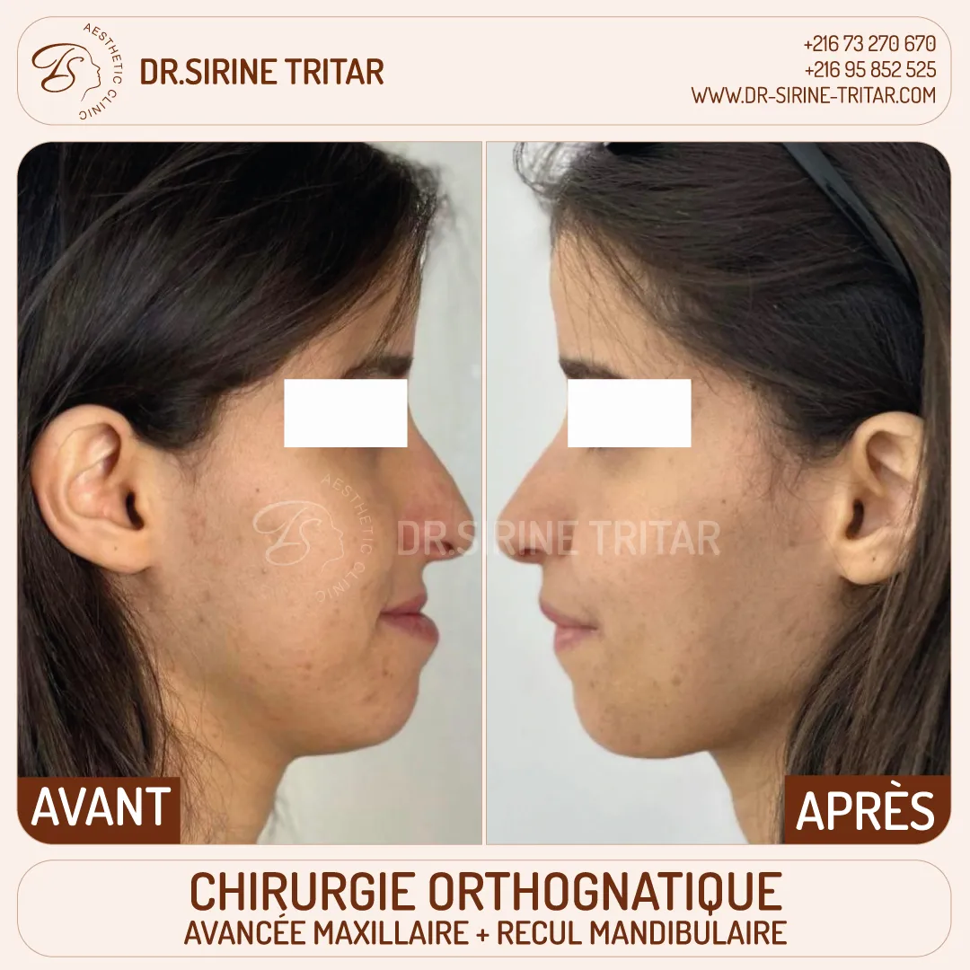Chirurgie orthognatique Sousse Tunisie