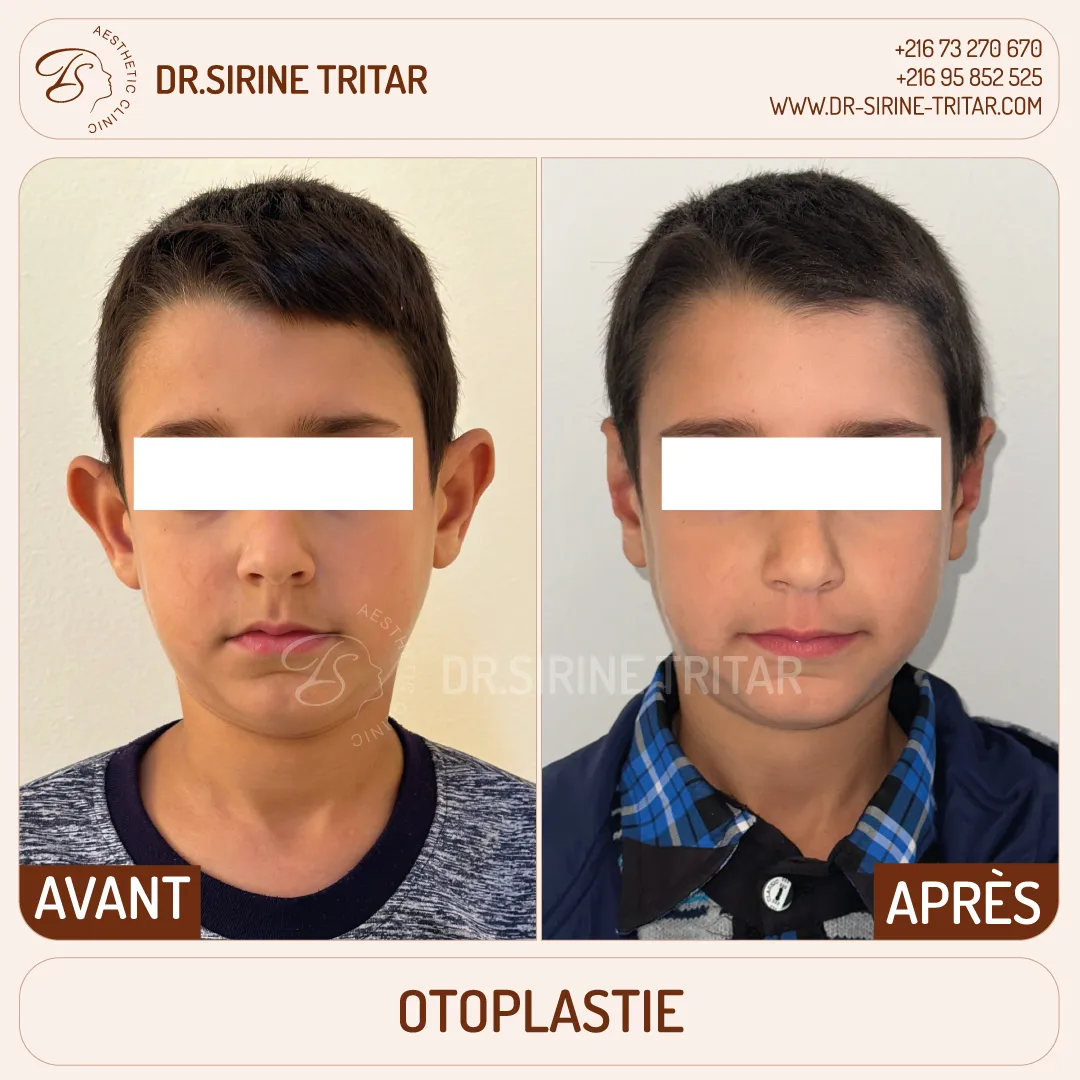 Otoplastie Sousse Tunisie