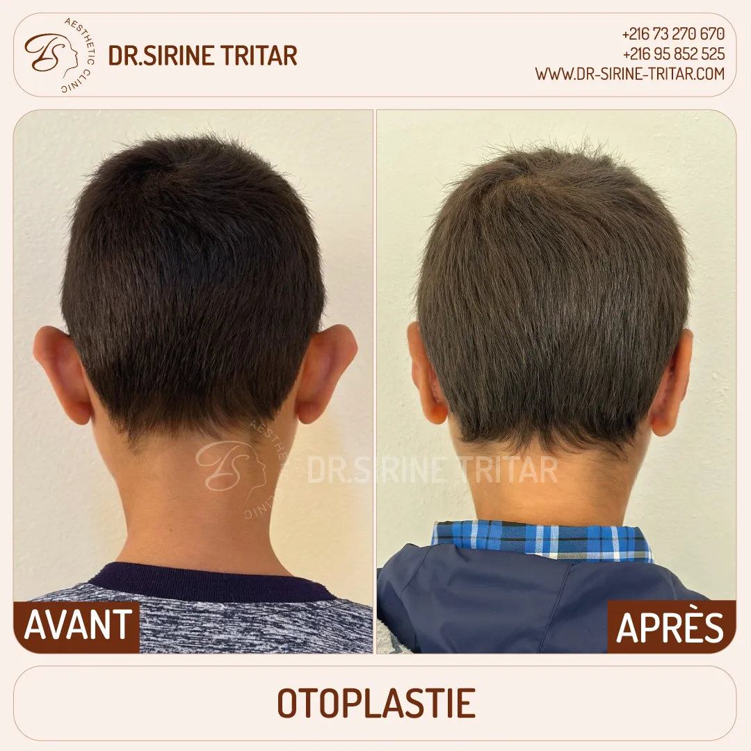 Otoplastie Sousse Tunisie