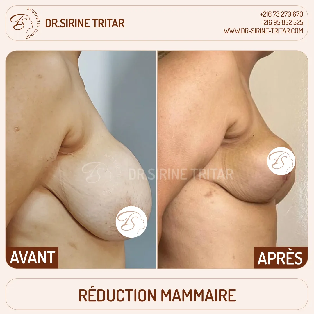 Réduction mammaire Sousse Tunisie