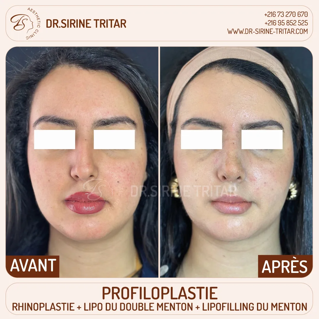 Rhinoplastie Sousse Tunisie
