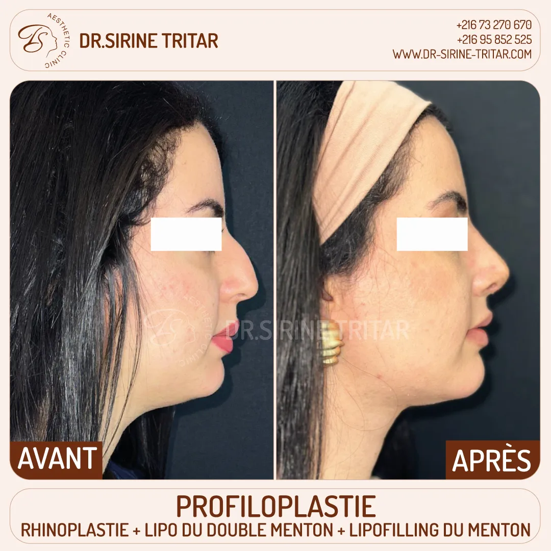 Rhinoplastie Sousse Tunisie