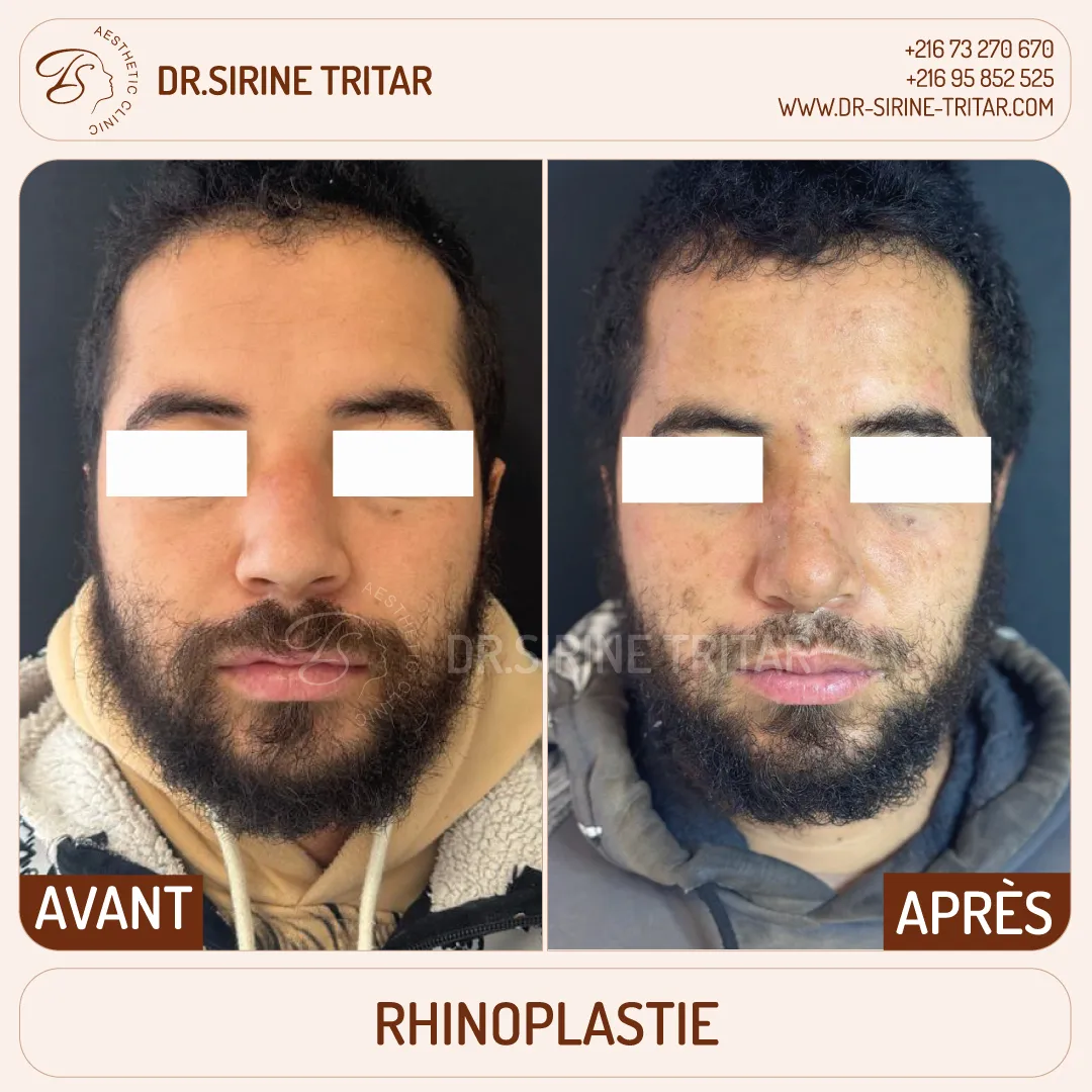 Rhinoplastie Sousse Tunisie