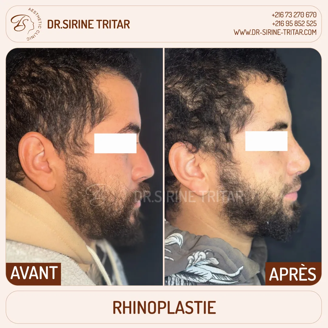 Rhinoplastie Sousse Tunisie