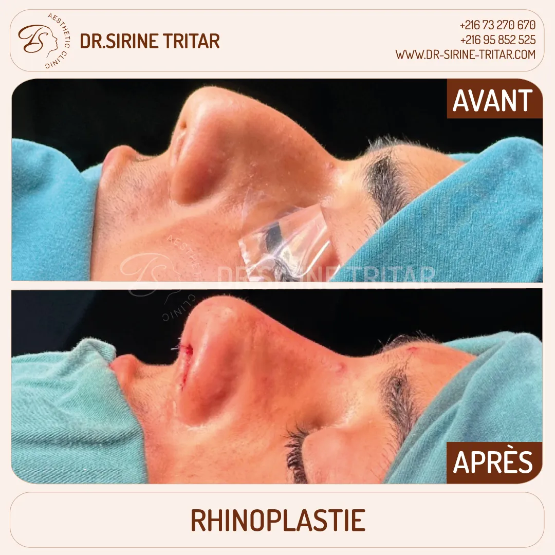 Rhinoplastie Sousse Tunisie
