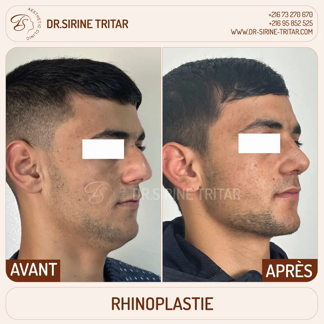 Rhinoplastie Sousse Tunisie