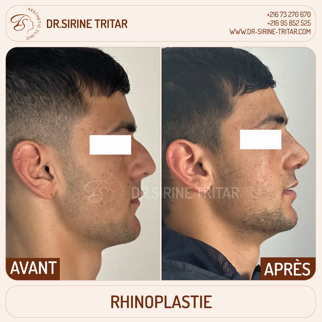 Rhinoplastie Sousse Tunisie