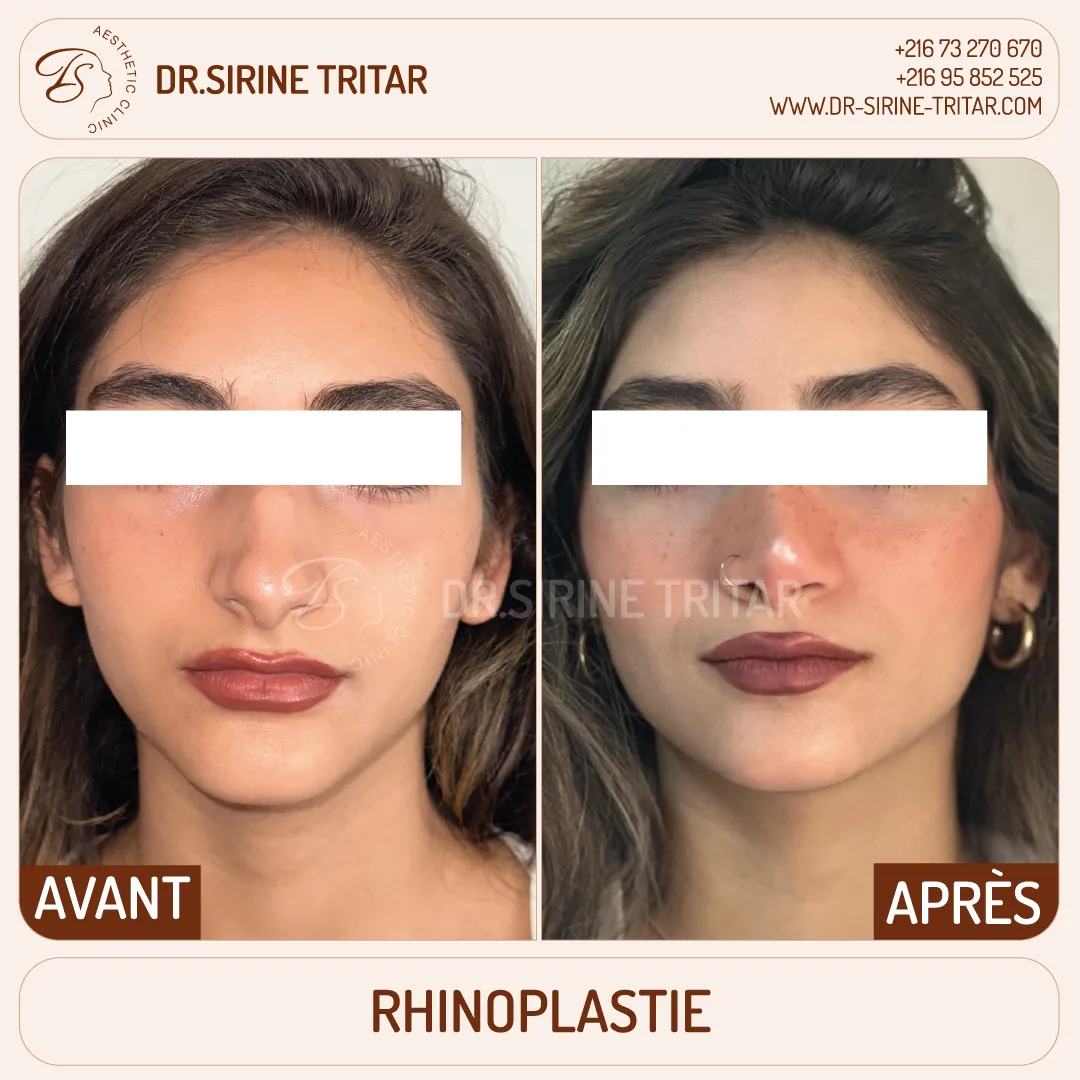 Rhinoplastie Sousse Tunisie