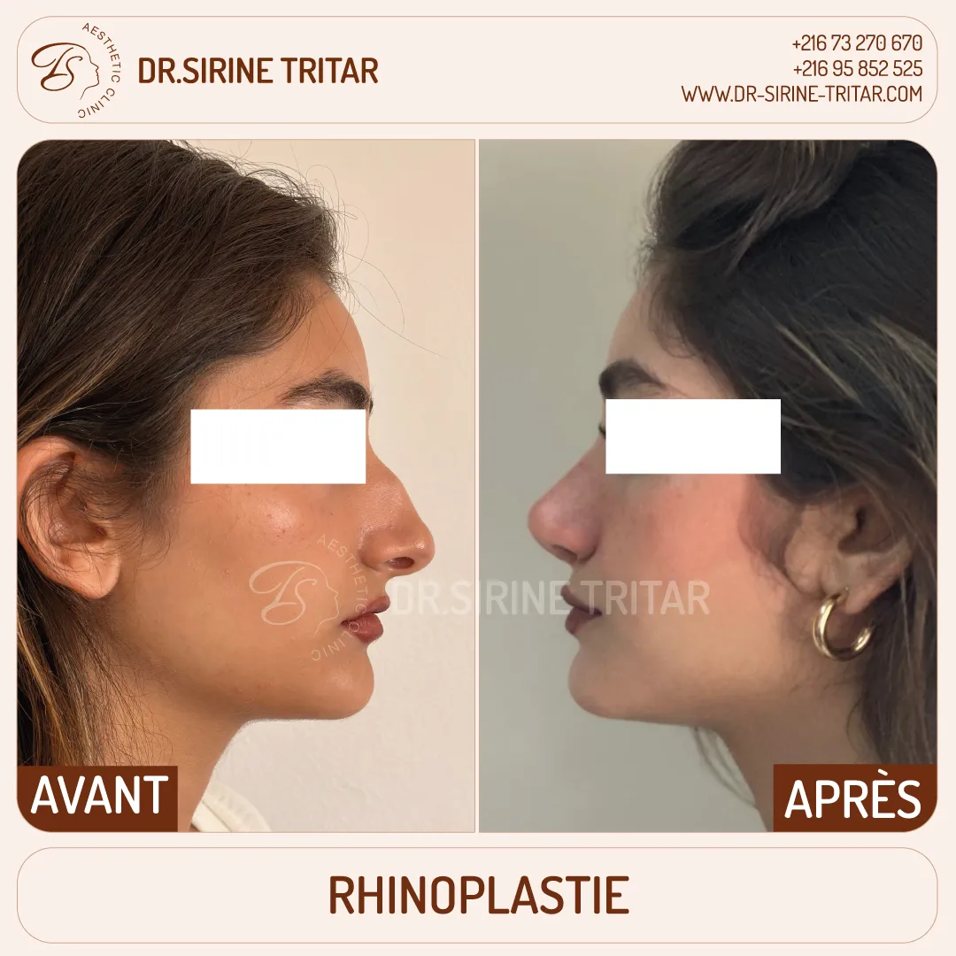 Rhinoplastie Sousse Tunisie