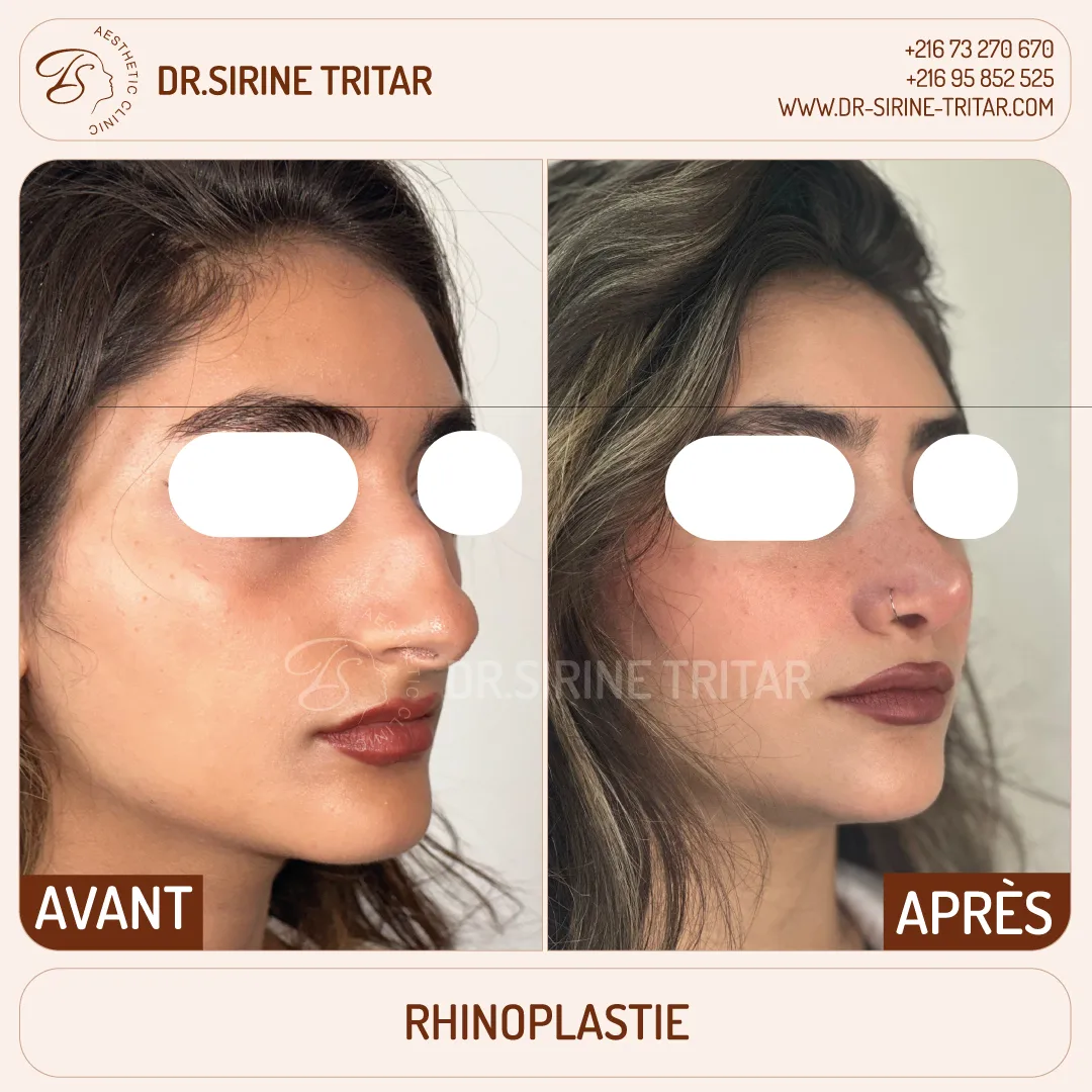 Rhinoplastie Sousse Tunisie