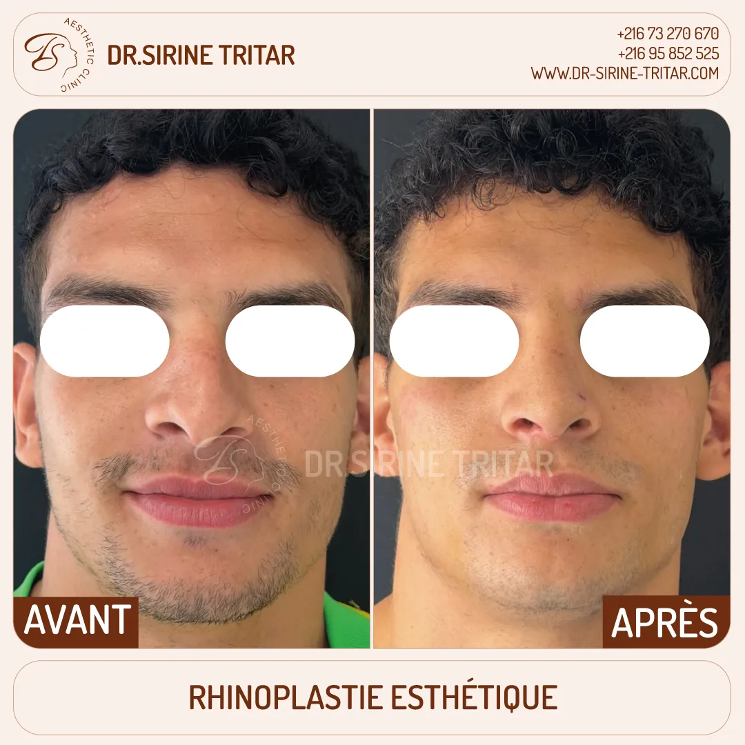 Rhinoplastie Sousse Tunisie