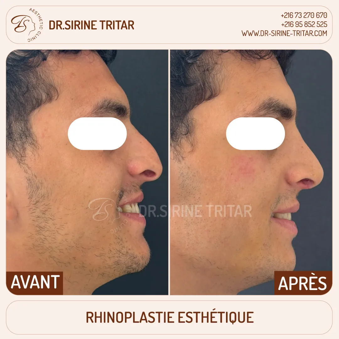 Rhinoplastie Sousse Tunisie