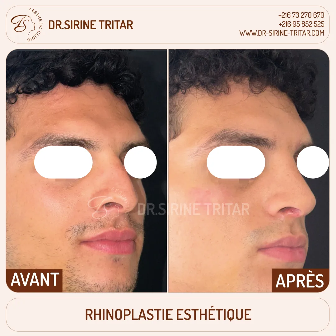 Rhinoplastie Sousse Tunisie