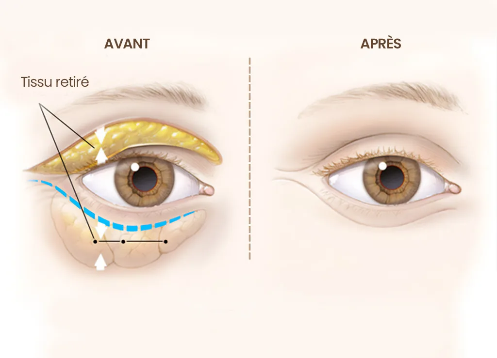 Blépharoplastie Sousse Tunisie