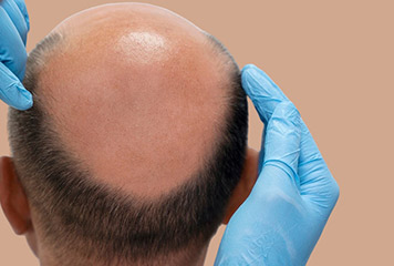 Greffe de cheveux Tunisie