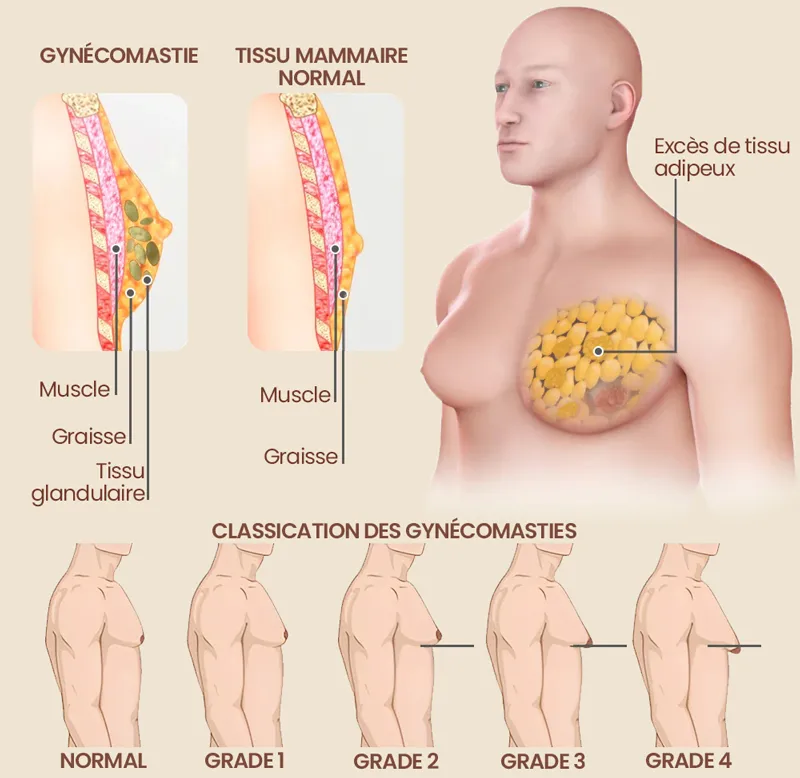 Gynécomastie Sousse Tunisie