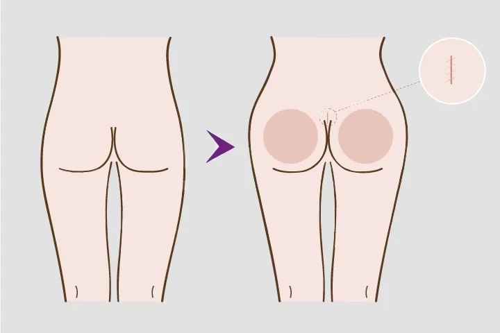 Implants fessiers Sousse Tunisie