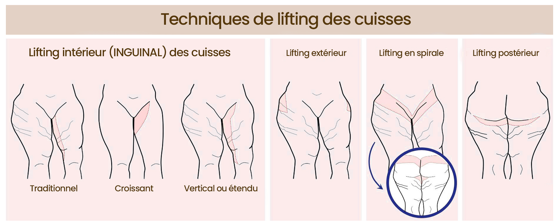 Lifting des cuisses Tunisie