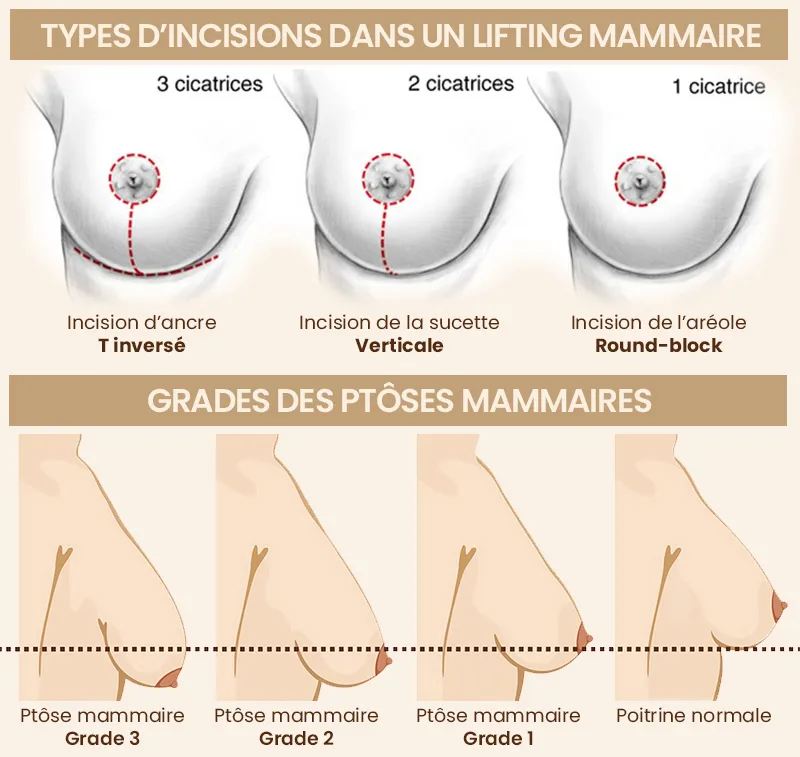 lifting mammaire Sousse Tunisie