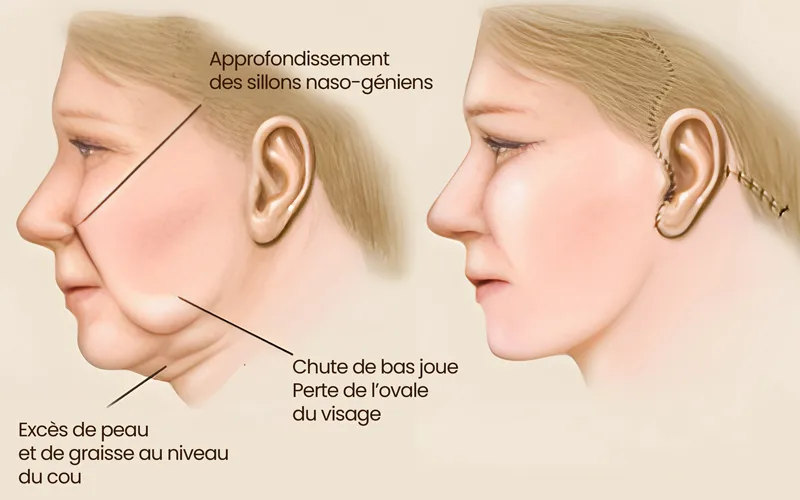 Lifting visage Sousse Tunisie