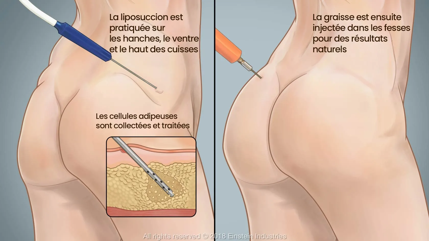 Lipofilling fesses Sousse Tunisie