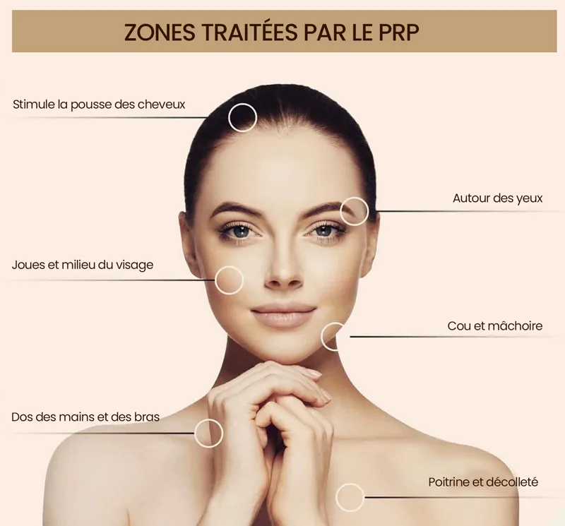 Injection PRP Sousse Tunisie