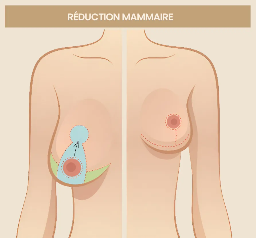 reduction mammaire Sousse Tunisie