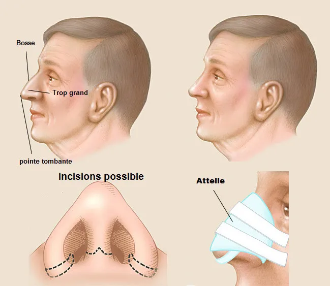 Rhinoplastie Sousse Tunisie